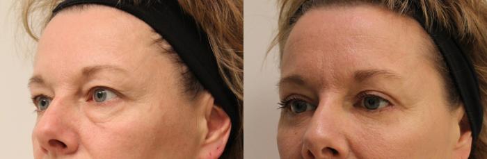 Before & After Eyelid Surgery (Blepharoplasty) Case 33 View #2 View in Barrington, Illinois