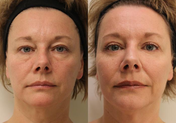 Before & After Eyelid Surgery (Blepharoplasty) Case 33 View #3 View in Barrington, Illinois