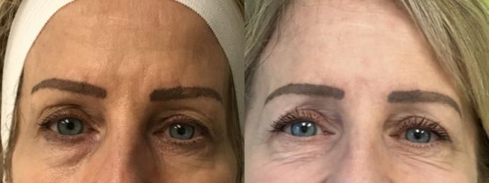 Before & After Eyelid Surgery (Blepharoplasty) Case 330 Front View in Barrington, Illinois