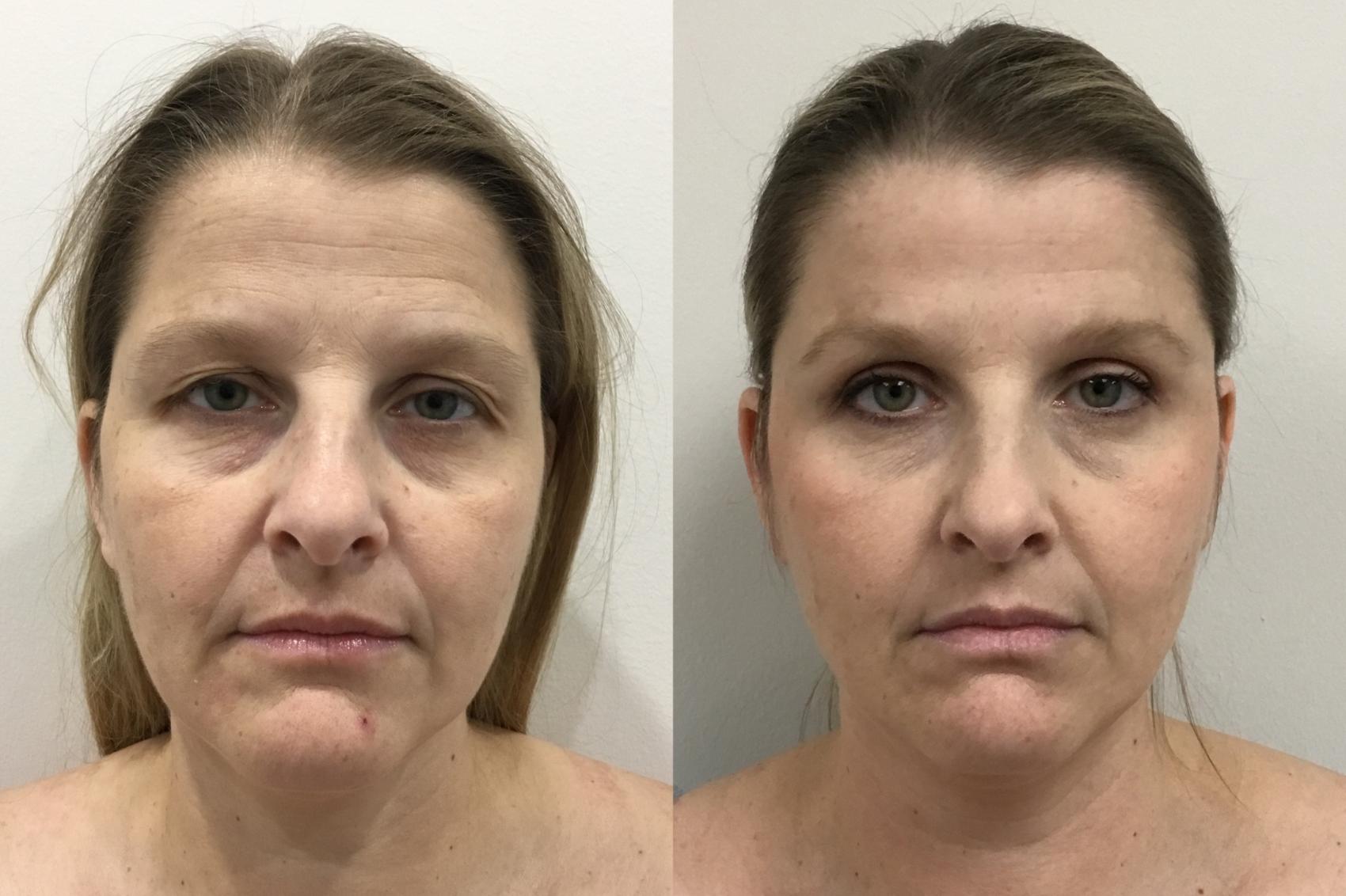 Before & After Eyelid Surgery (Blepharoplasty) Case 349 Front View in Barrington, Illinois