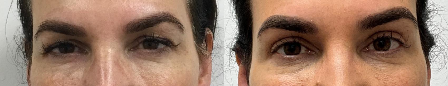 Before & After Eyelid Surgery (Blepharoplasty) Case 385 Front View in Barrington, Illinois