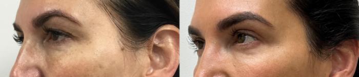 Before & After Eyelid Surgery (Blepharoplasty) Case 385 Left Oblique View in Barrington, Illinois