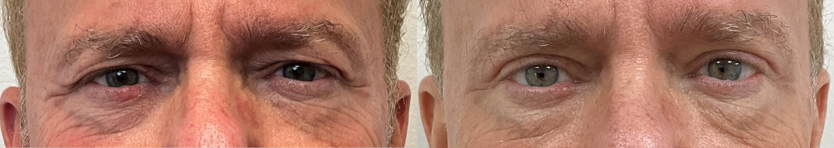 Before & After Eyelid Surgery (Blepharoplasty) Case 386 Front View in Barrington, Illinois