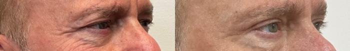 Before & After Eyelid Surgery (Blepharoplasty) Case 386 Right Oblique View in Barrington, Illinois