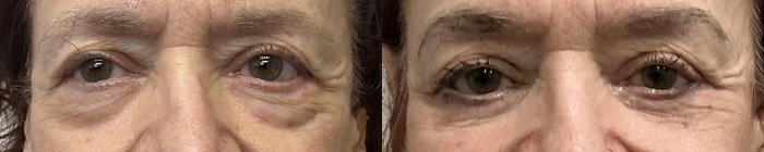 Before & After Eyelid Surgery (Blepharoplasty) Case 422 Front View in Barrington, Illinois