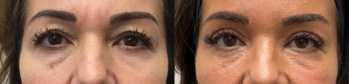 Before & After Eyelid Surgery (Blepharoplasty) Case 438 Front View in Barrington, Illinois