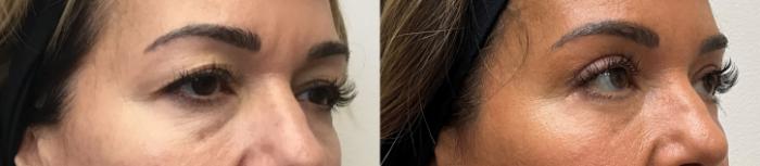 Before & After Eyelid Surgery (Blepharoplasty) Case 438 Right Oblique View in Barrington, Illinois