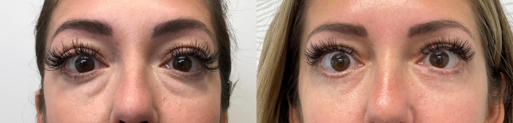 Before & After Eyelid Surgery (Blepharoplasty) Case 439 Front View in Barrington, Illinois