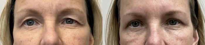 Before & After Eyelid Surgery (Blepharoplasty) Case 443 Front View in Barrington, Illinois