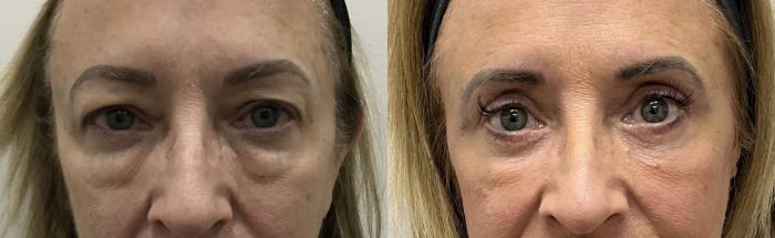 Before & After Eyelid Surgery (Blepharoplasty) Case 444 Front View in Barrington, Illinois