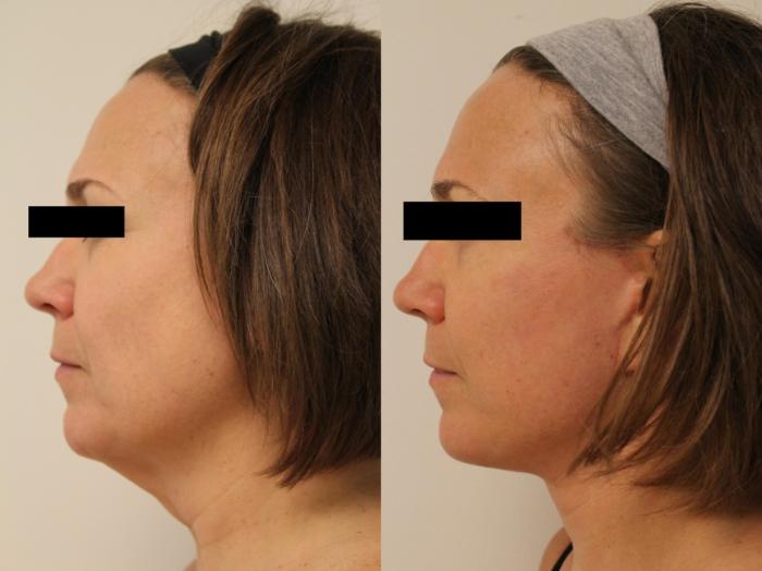 Before & After Facelift & Neck Lift Case 109 Left Side View in Barrington, Illinois