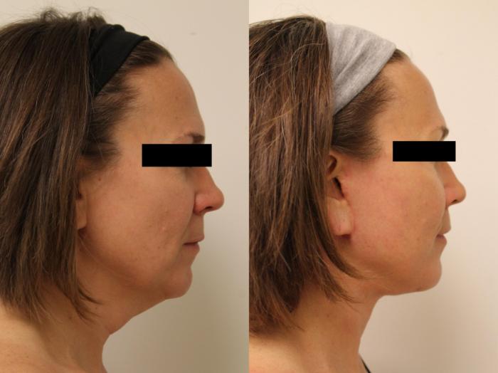 Before & After Facelift & Neck Lift Case 109 Right Side View in Barrington, Illinois