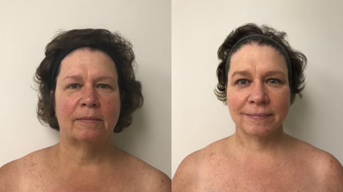 Before & After Facelift & Neck Lift Case 206 Front View in Barrington, Illinois