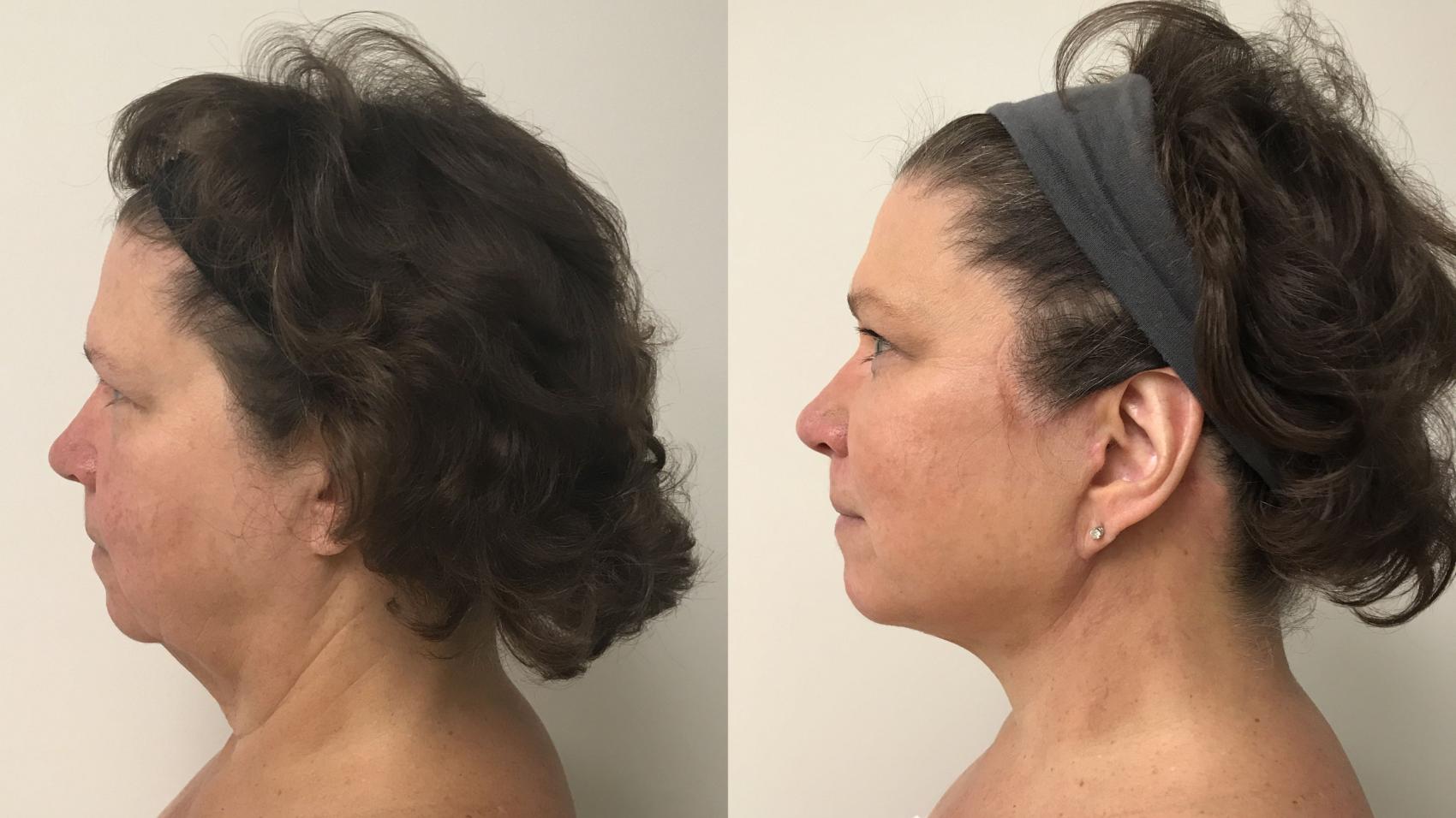 Before & After Facelift & Neck Lift Case 206 Left Side View in Barrington, Illinois
