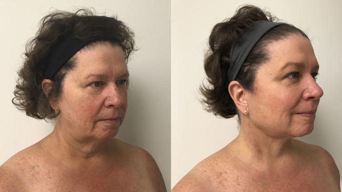 Before & After Facelift & Neck Lift Case 206 Right Oblique View in Barrington, Illinois
