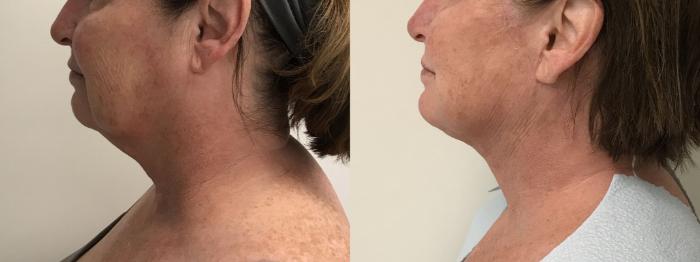 Before & After Facelift & Neck Lift Case 222 Left Side View in Barrington, Illinois