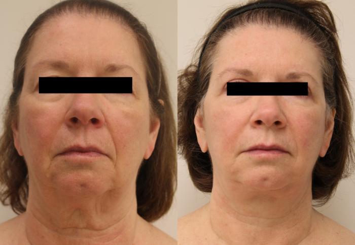 Before & After Facelift & Neck Lift Case 28 View #1 View in Barrington, Illinois