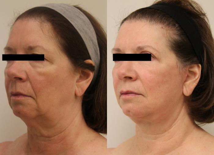 Before & After Facelift & Neck Lift Case 28 View #2 View in Barrington, Illinois