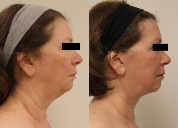 Before & After Facelift & Neck Lift Case 28 View #3 View in Barrington, Illinois