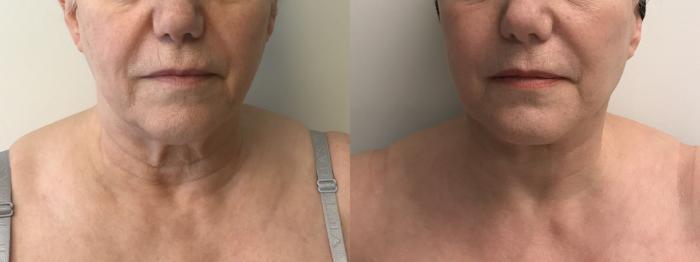 Before & After Facelift & Neck Lift Case 280 Front View in Barrington, Illinois