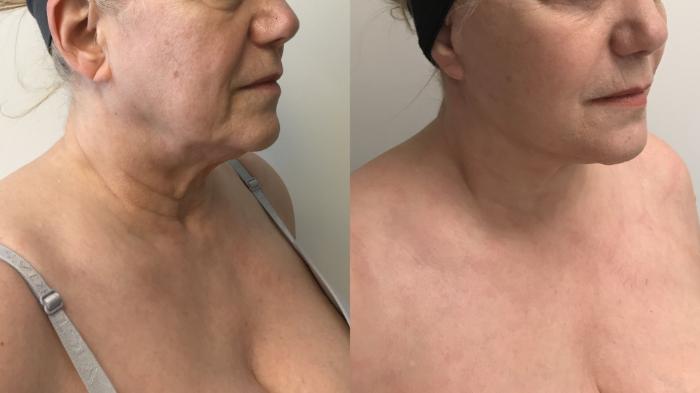 Before & After Facelift & Neck Lift Case 280 Right Oblique View in Barrington, Illinois