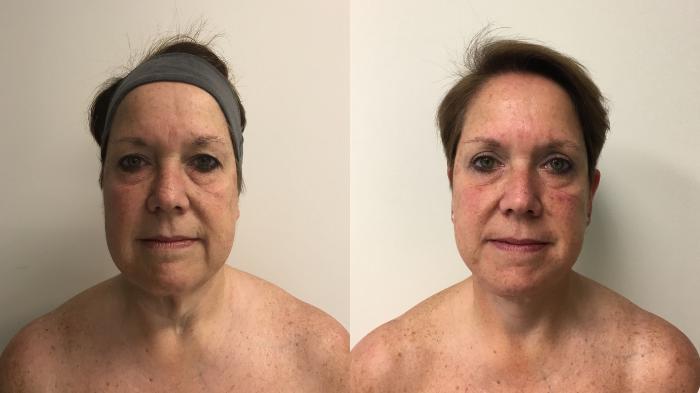 Before & After Facelift & Neck Lift Case 300 Front View in Barrington, Illinois