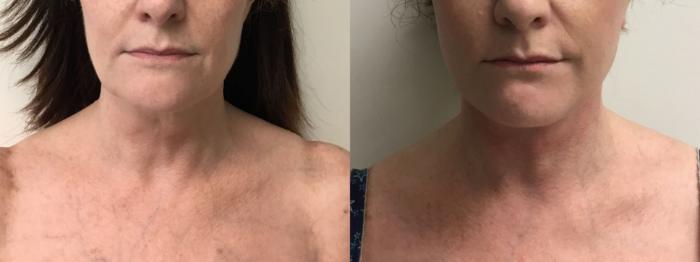 Before & After Facelift & Neck Lift Case 301 Front View in Barrington, Illinois