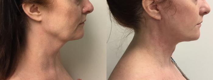 Before & After Facelift & Neck Lift Case 301 Right Side View in Barrington, Illinois