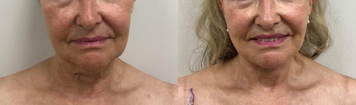 Before & After Facelift & Neck Lift Case 369 Front View in Barrington, Illinois