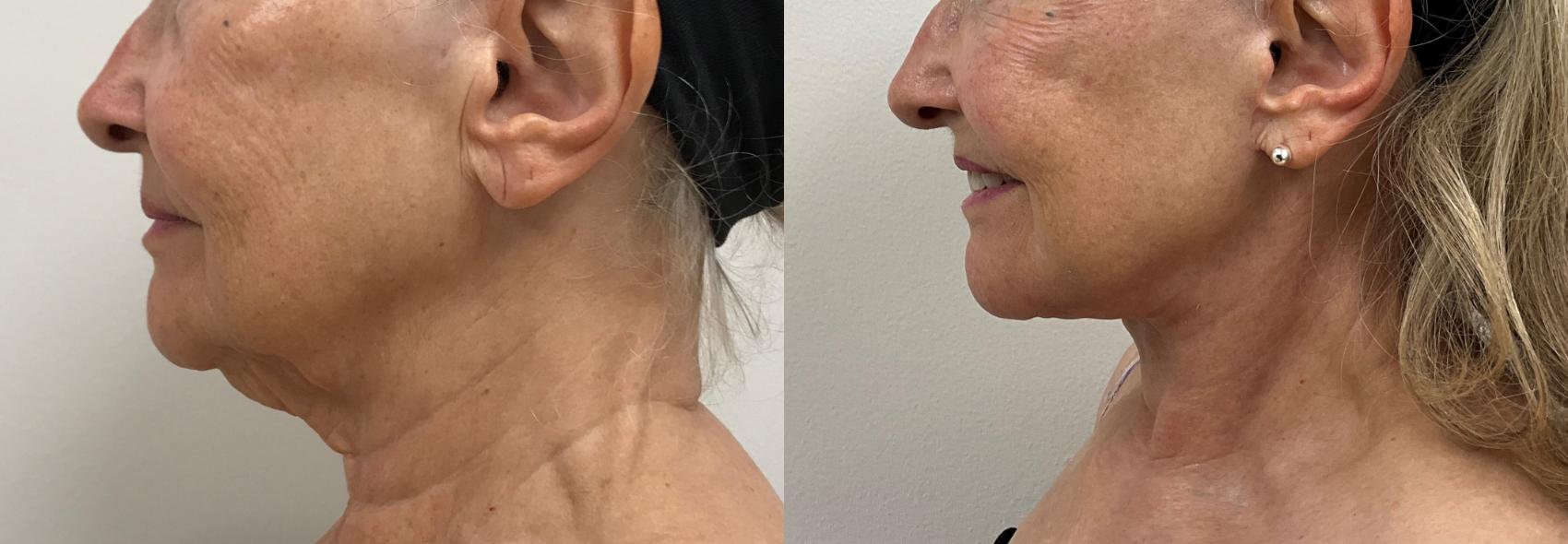 Before & After Facelift & Neck Lift Case 369 Left Side View in Barrington, Illinois