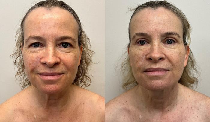 Before & After Eyelid Surgery (Blepharoplasty) Case 384 Front View in Barrington, Illinois