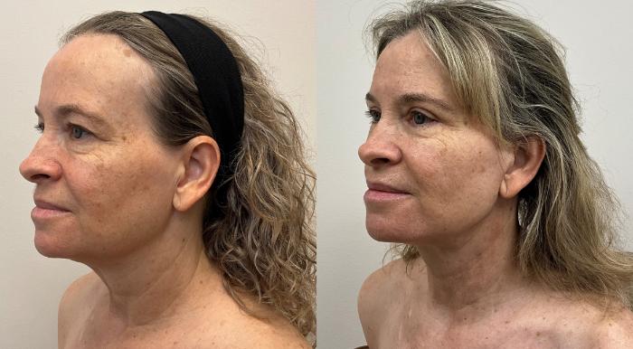 Before & After Facelift & Neck Lift Case 384 Left Side View in Barrington, Illinois