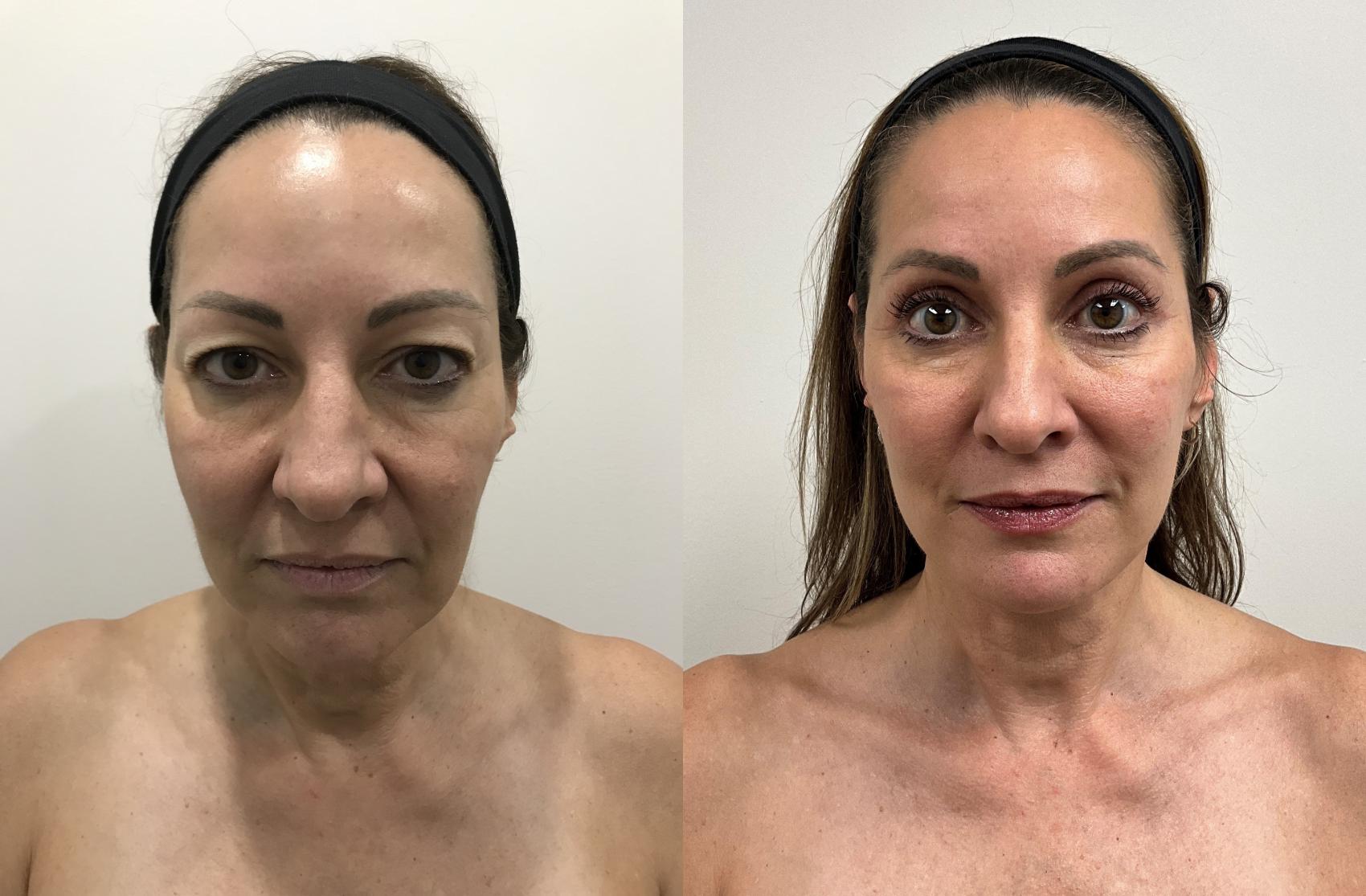 Before & After Facelift & Neck Lift Case 392 Front View in Barrington, Illinois