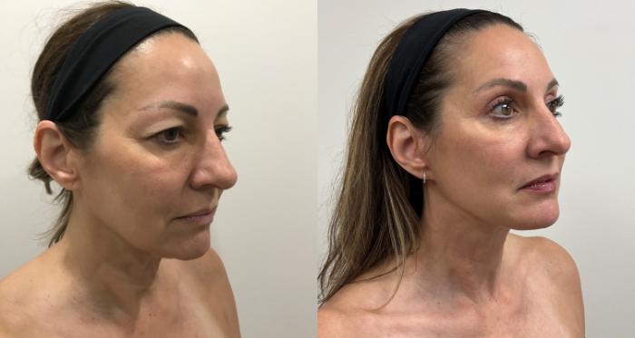 Before & After Facelift & Neck Lift Case 392 Right Oblique View in Barrington, Illinois