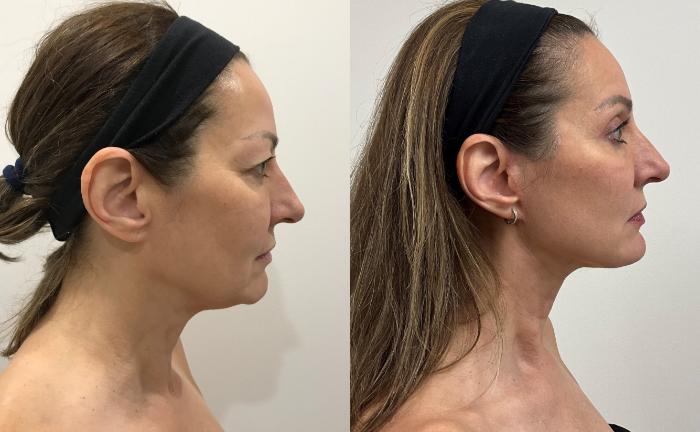 Before & After Facelift & Neck Lift Case 392 Right Side View in Barrington, Illinois