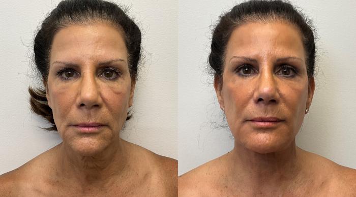 Before & After Facial Fat Grafting Case 393 Front View in Barrington, Illinois