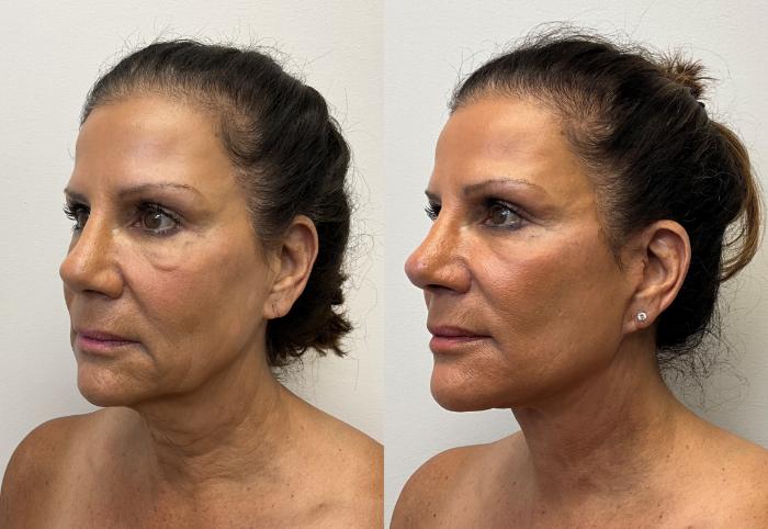 Before & After Facial Fat Grafting Case 393 Left Oblique View in Barrington, Illinois