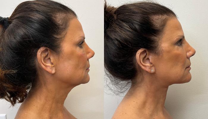 Before & After Facelift & Neck Lift Case 393 Right Side View in Barrington, Illinois