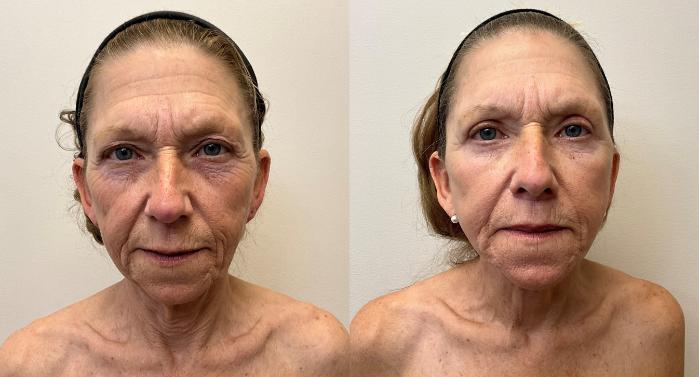 Before & After Facelift & Neck Lift Case 426 Front View in Barrington, Illinois