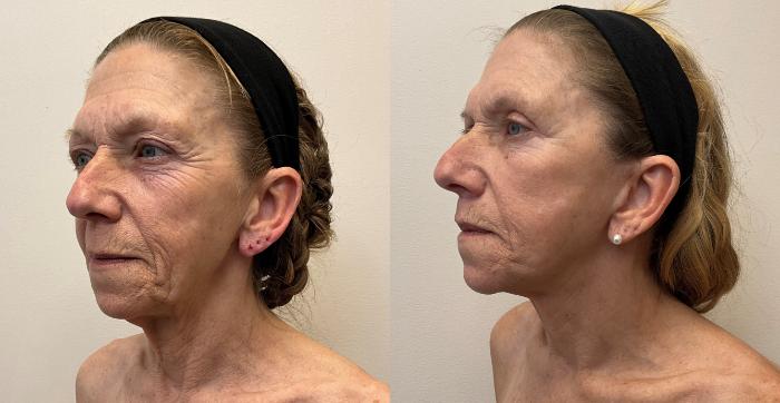 Before & After Eyelid Surgery (Blepharoplasty) Case 426 Left Oblique View in Barrington, Illinois