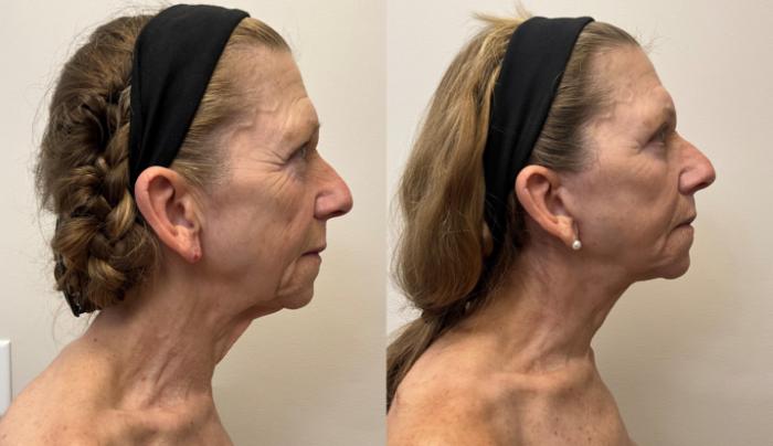 Before & After Facelift & Neck Lift Case 426 Right Side View in Barrington, Illinois
