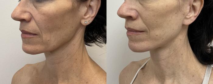 Before & After Facelift & Neck Lift Case 450 Front View in Barrington, Illinois