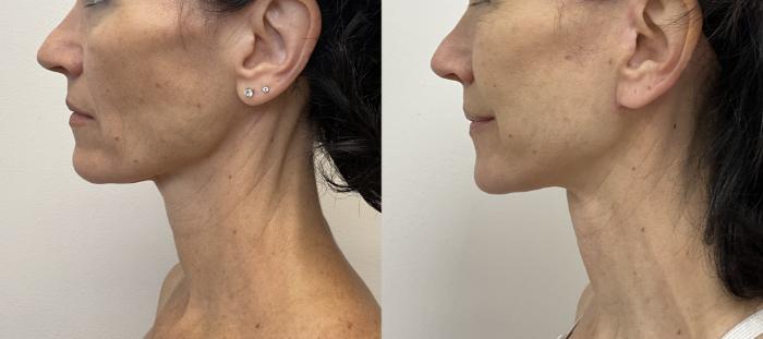 Before & After Facelift & Neck Lift Case 450 Left Side View in Barrington, Illinois