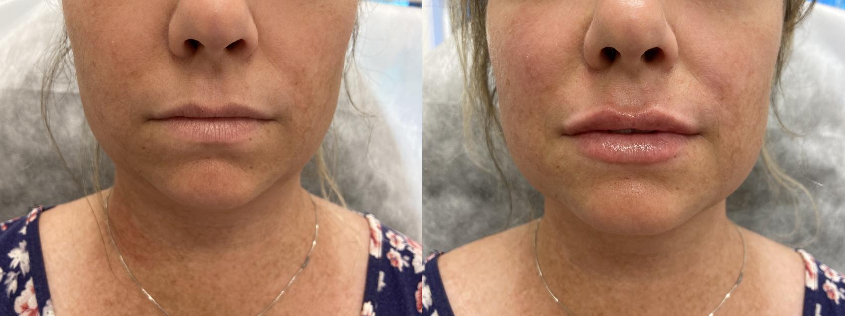 Before & After Injectables- Savannah, RN Case 343 Front View in Barrington, Illinois