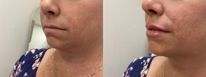 Before & After Injectables- Savannah, RN Case 343 Left Oblique View in Barrington, Illinois
