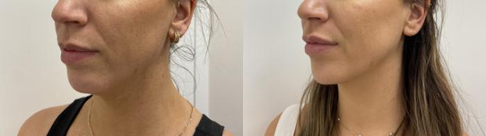 Before & After Injectables- Savannah, RN Case 344 Left Oblique View in Barrington, Illinois
