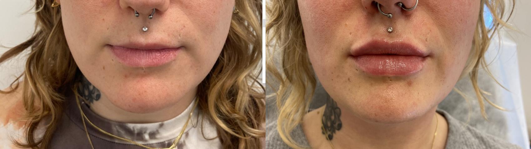 Before & After Injectables- Savannah, RN Case 345 Front View in Barrington, Illinois