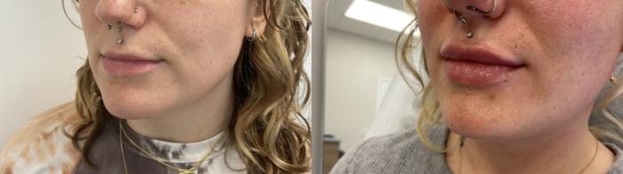 Before & After Injectables- Savannah, RN Case 345 Left Oblique View in Barrington, Illinois