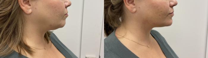 Before & After Injectables- Savannah, RN Case 346 Left Side View in Barrington, Illinois