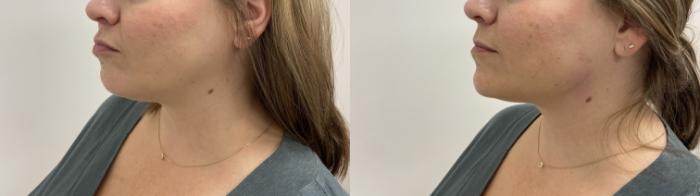 Before & After Injectables- Savannah, RN Case 346 Right Side View in Barrington, Illinois